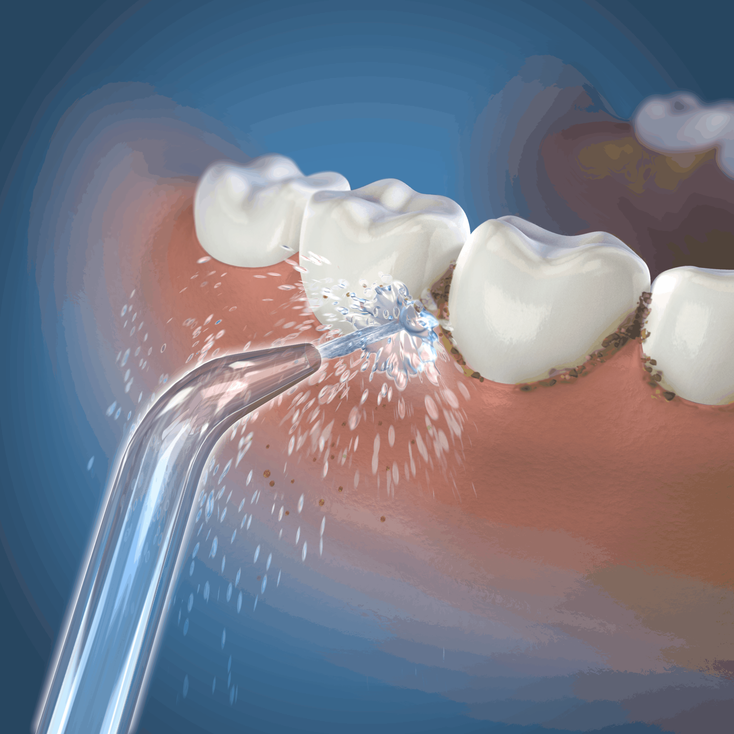 Paradantozė (periodontitas) – kaip ją įveikti?