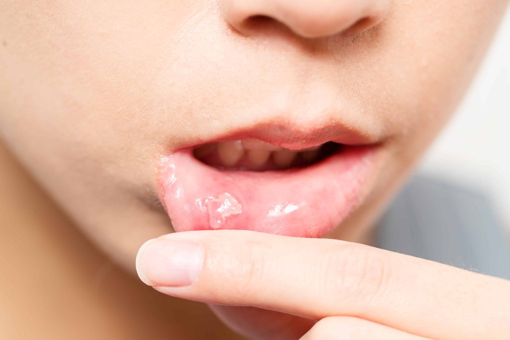 Stomatito prevencija: patarimai, kaip užtikrinti gerą burnos sveikatą