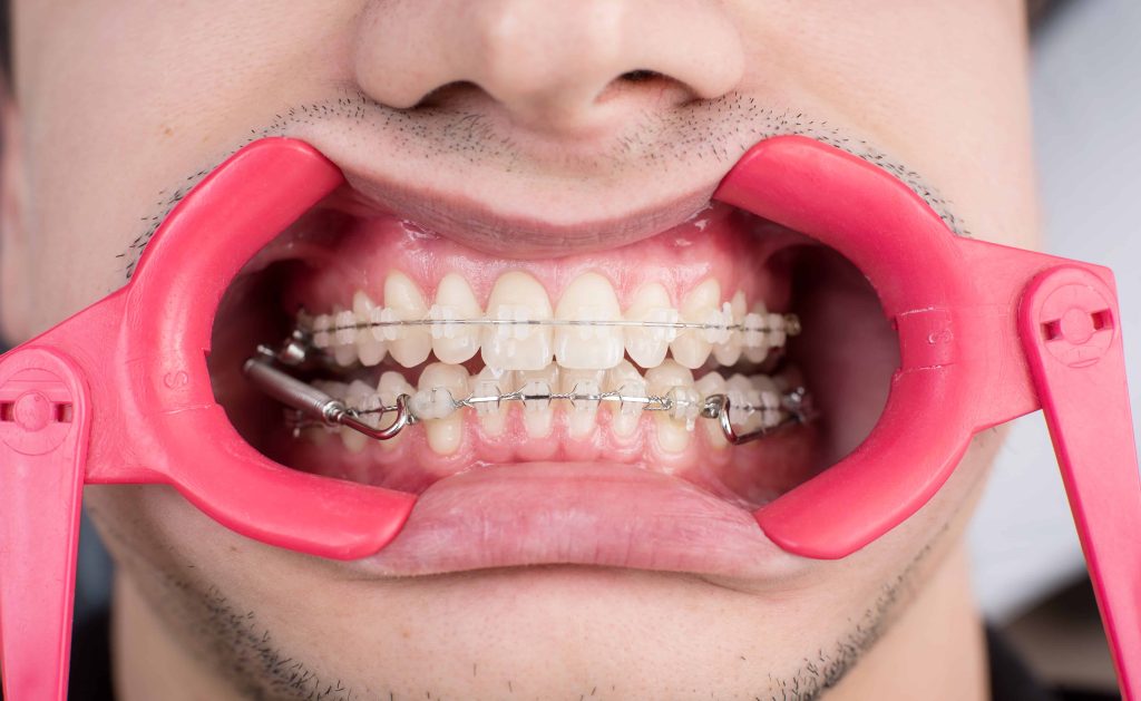 Baltos dantenos: ką tai galėtų reikšti ir ko imtis susidūrus su šiuo požymiu?