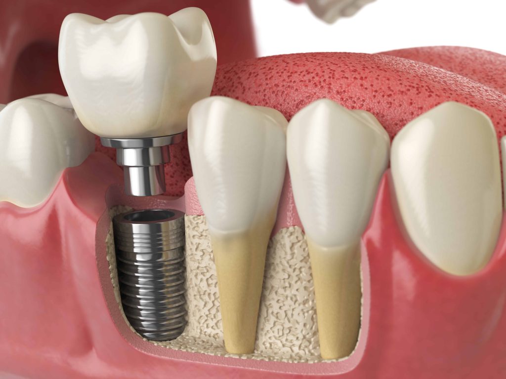 Kasdienės dantų implantų priežiūros rekomendacijos