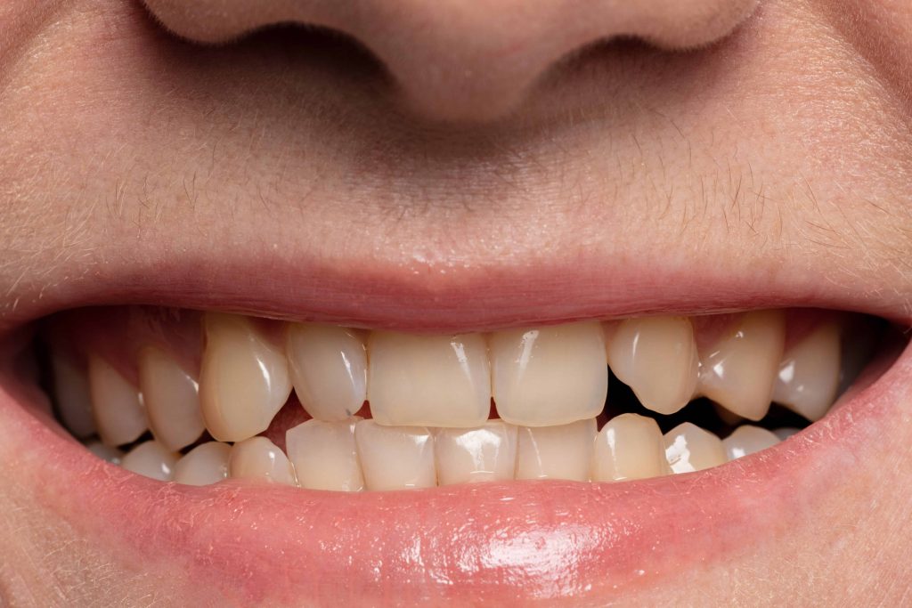 Geltoni dantys: priežastys, prevencija ir gydymo būdai