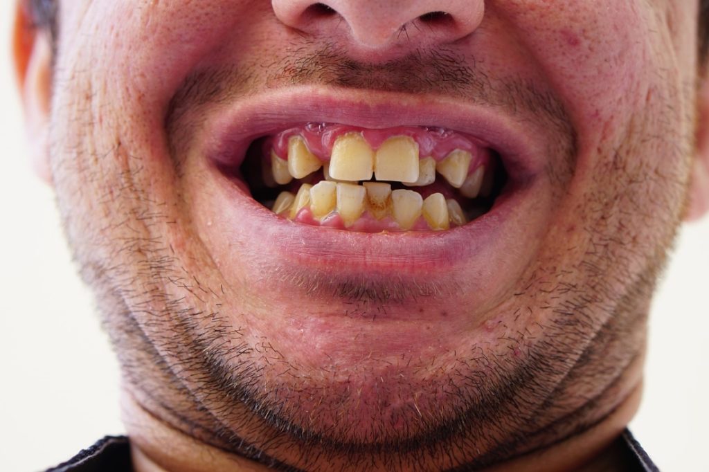 Dantų erozija: Kaip išsaugoti šypseną?