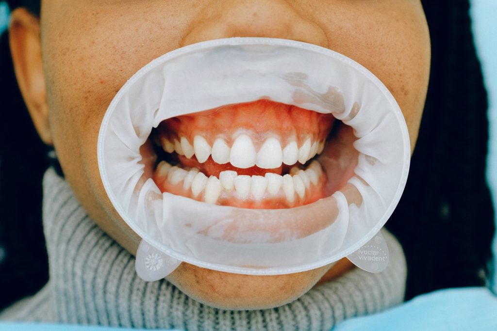 Perikoronitas: Kaip sumažinti skausmą dygstant dantims?